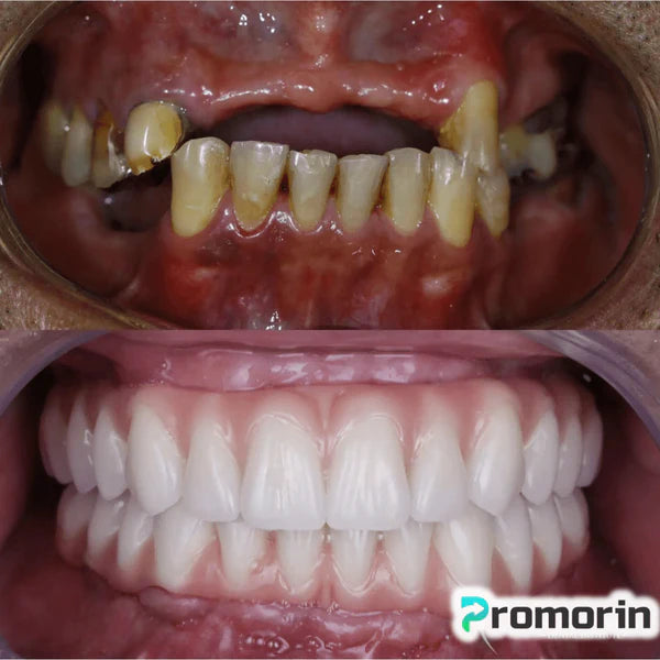 Dentadura de Silicone FIX | Ajustavel e Adaptativa Saúde & Beleza (Dentadura 1) Dm Stores